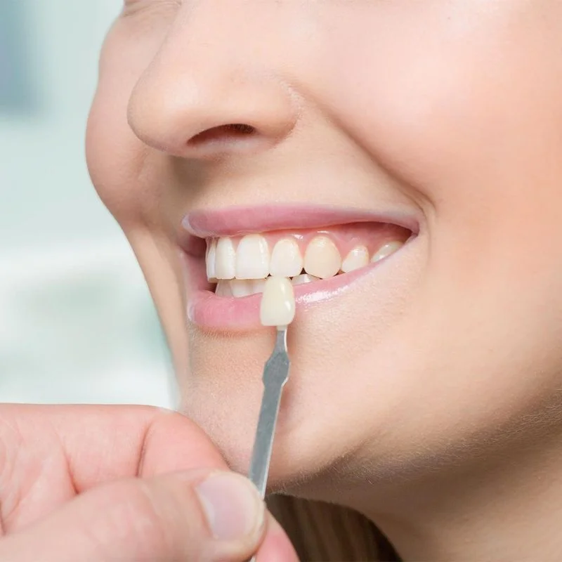 Close-up of dentist matching a porcelain veneer shade to patient's upper front teeth