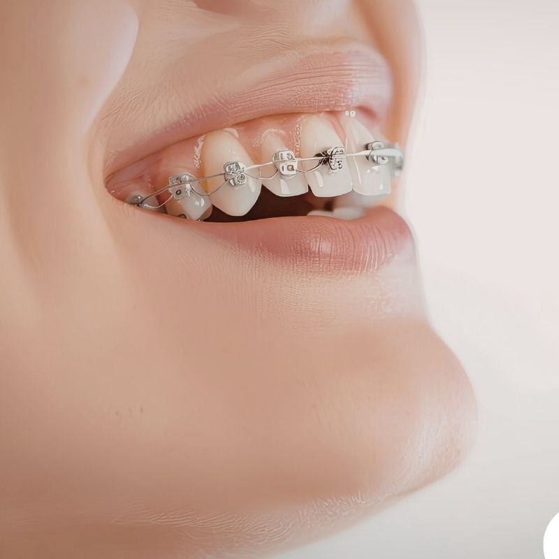 Close-up of patient's teeth with metal orthodontic braces and wire