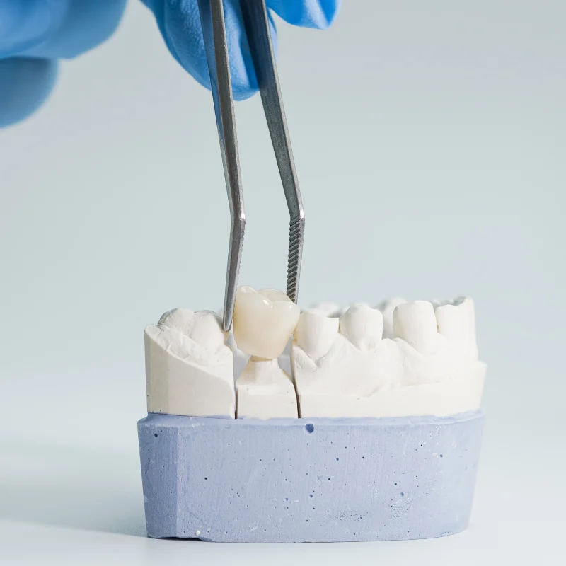Dental Bridges in Waterloo at Parkside Drive Dental in Waterloo, ON