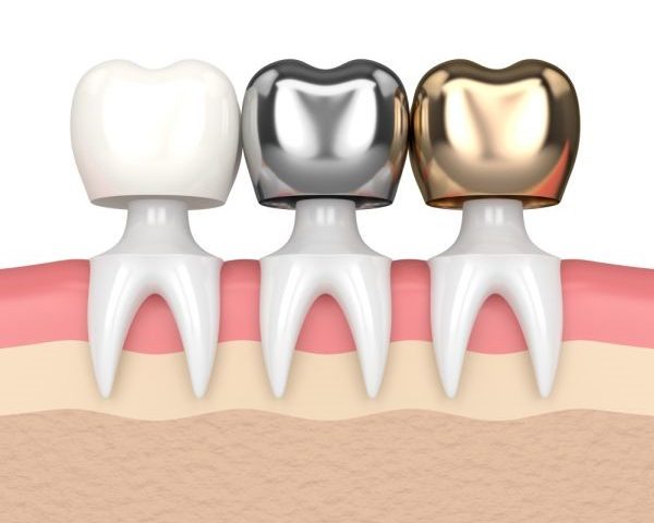 How Dental Crowns Can Enhance Your Smile