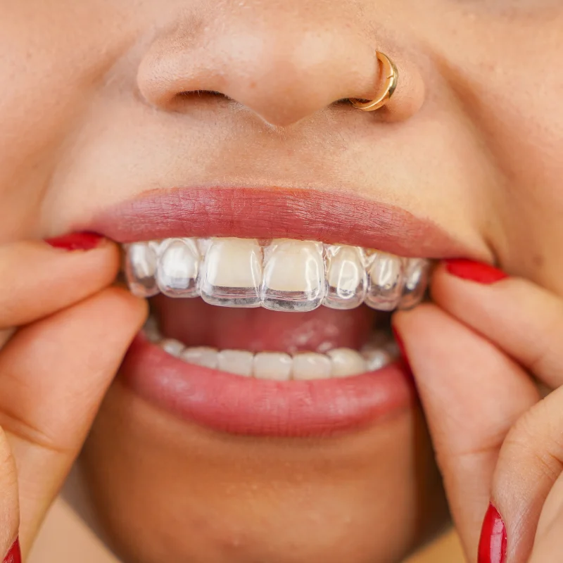 Close-up of patient inserting a clear Invisalign aligner onto upper teeth