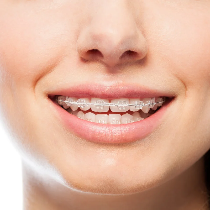 Close-up of smiling patient wearing clear ceramic braces on upper and lower teeth