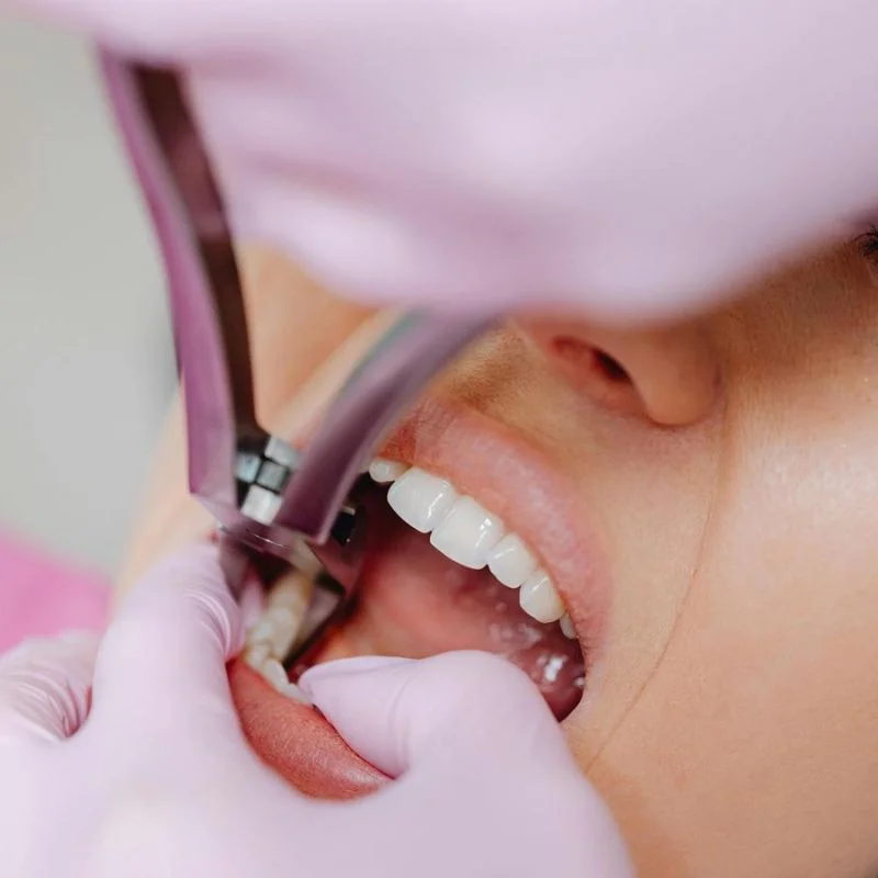 Close-up of dentist using forceps to perform tooth extraction on patient